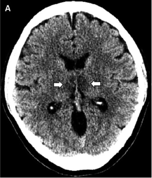 КТ головного мозга пациентки. Стрелочками показаны поражения таламусов (гиподенсные зоны). Credit: Brent Griffith et al. / Radiology 2020