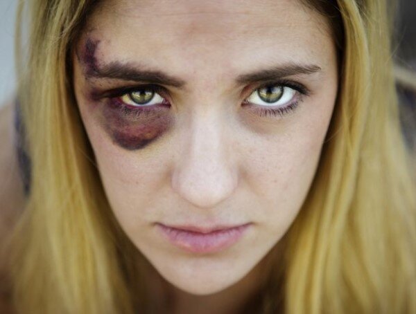 Как быстро избавиться от гематомы, не выпадая из активной жизни? (листаем вправо)