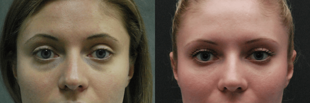 Липофилингом нижних век мы скрыли синяки и грыжи под глазами. Фото с сайта Д.Р. Гришкяна. Имеются противопоказания. Требуется консультация специалиста