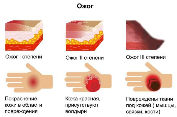 Как вылечить термический ожог дома