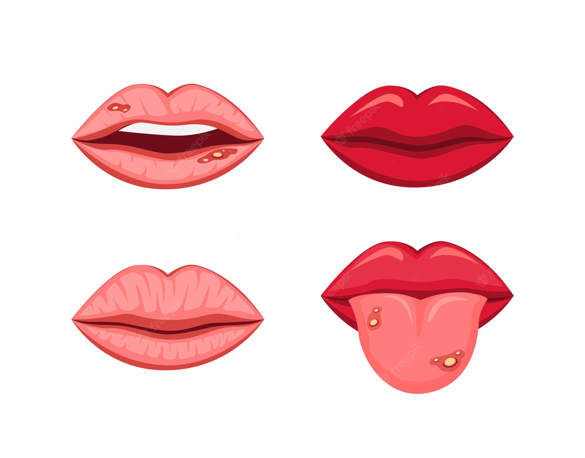 https://img.freepik.com/free-vector/mouth-lips-with-tongue-healthy-and-disease-ulcer-stomatitis-in-cartoon-illustration_201904-787.jpg?w=2000