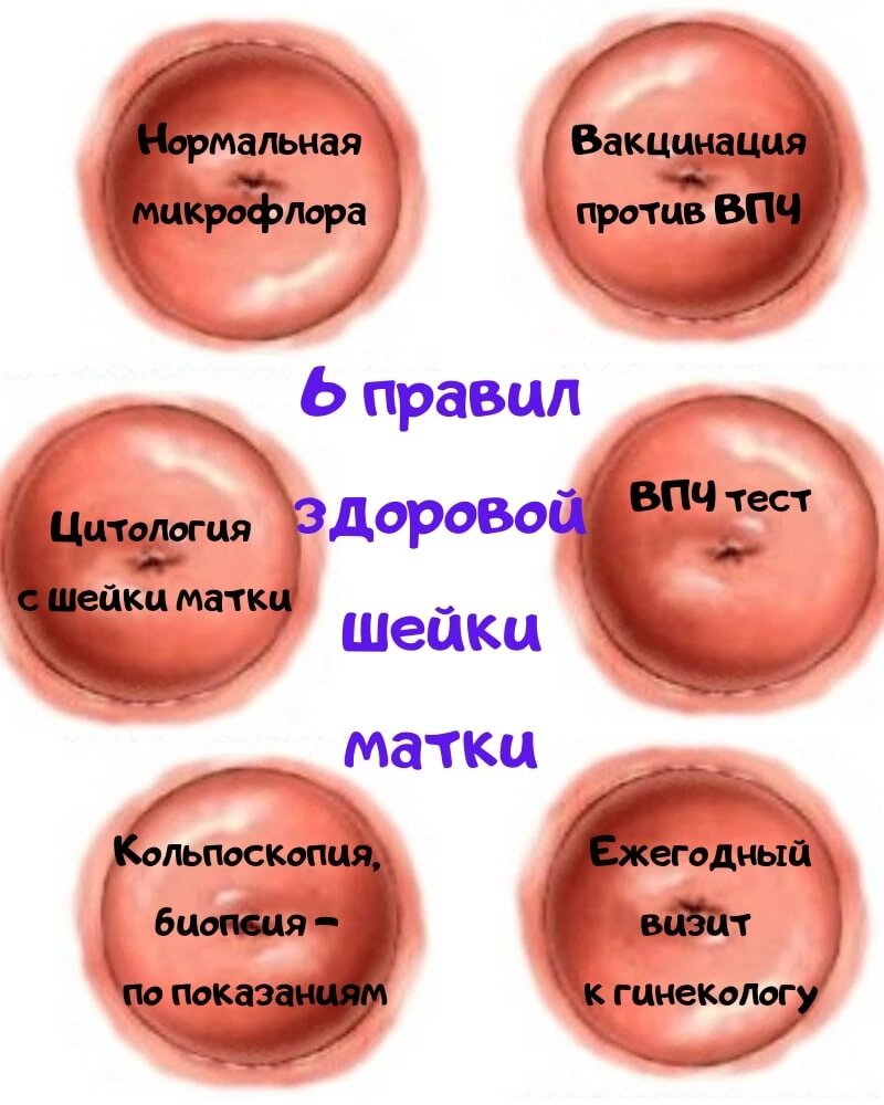 Рак шейки матки полностью предотвратим при ежегодном посещении врача - гинеколога. 