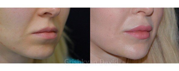 Липофилинг губ фото до и после. Фото с сайта Д.Р. Гришкяна. Имеются противопоказания, требуется консультация специалиста
