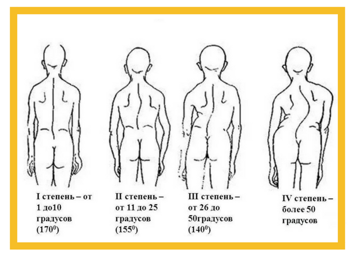 Степени сколиоза