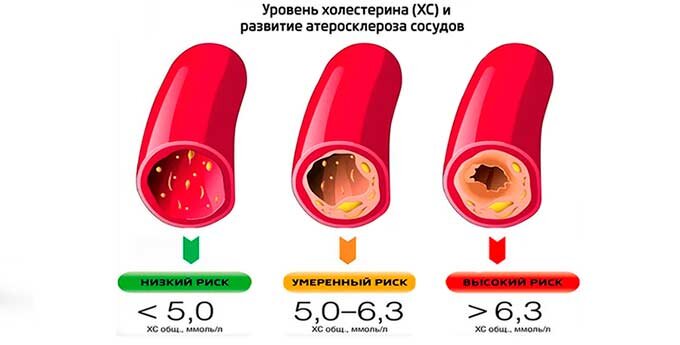 Причины повышения холестерина