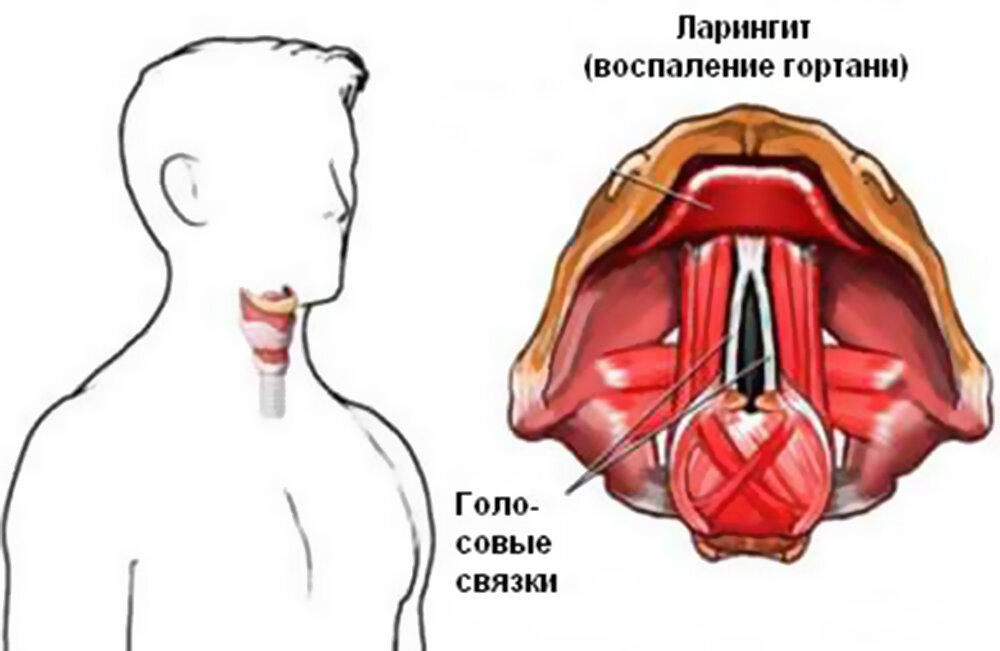 Чем лечить ларингит. Подскладочный ларингит. Абсцедирующий ларингит. Голосовые связки ларингит.