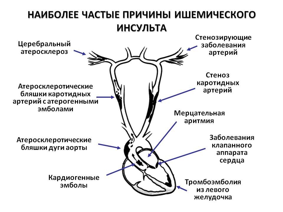 От чего происходит инсульт простыми словами. Причины ишемического инсульта. Предпосылки ишемического инсульта. Ишемический инсульт причины возникновения. Наиболее частая причина ишемического инсульта.