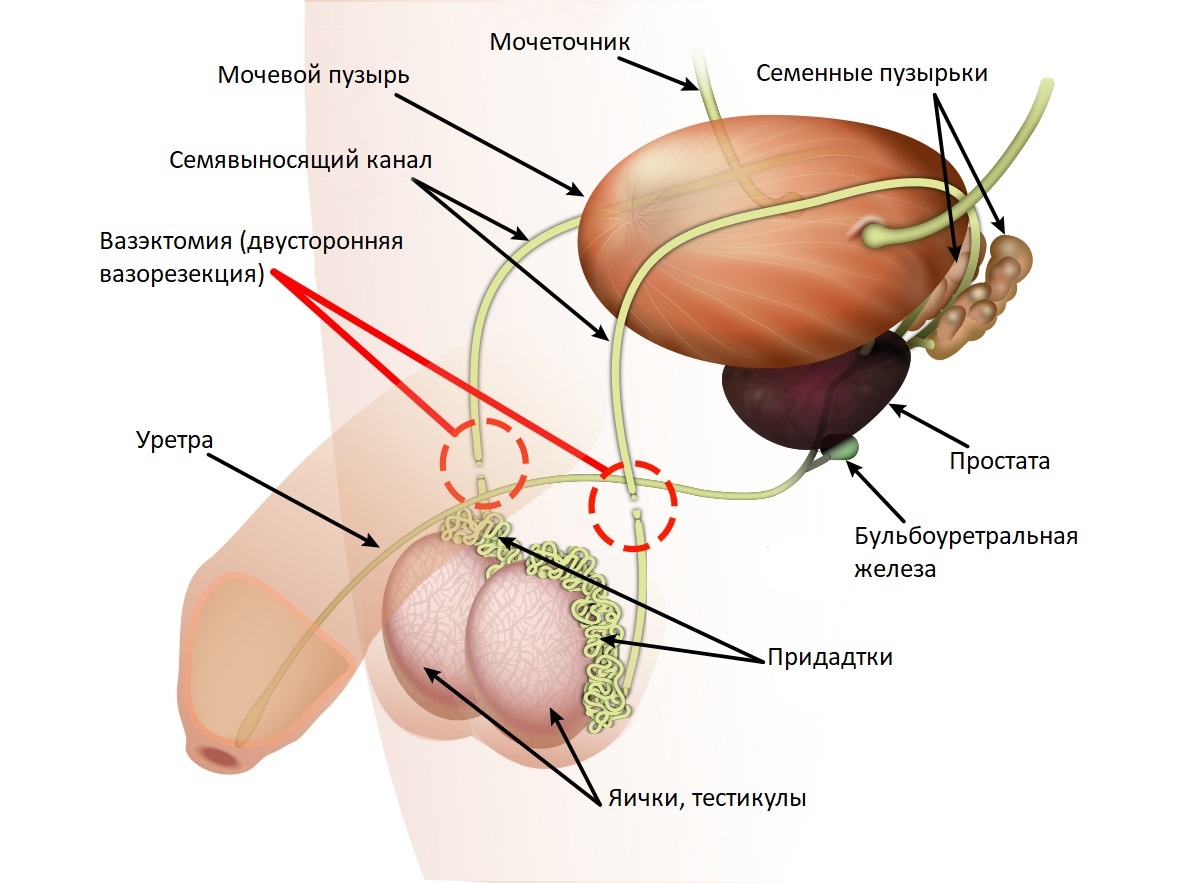 Другими словами - мужская стерилизация.  Операция ,при которой происходит иссечение фрагмента семявыносящего протока либо его клепирование или перевязка.-2