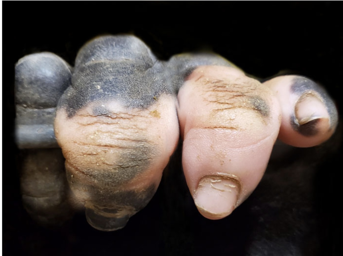 Пальцы (с нарушением пигментации) гориллы по кличке Анака из зоопарка Атланты в США. Источник: https://parawebnews.com.br/