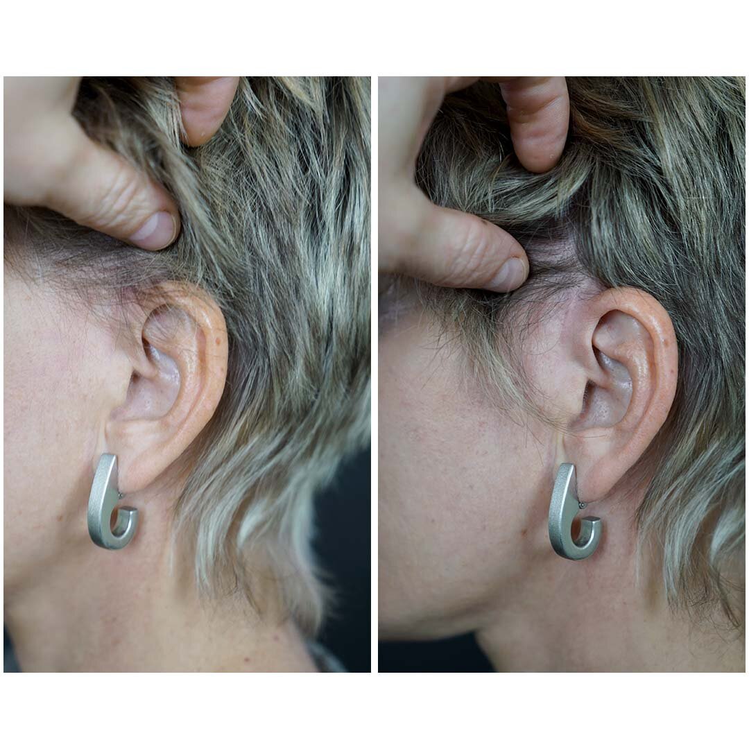 Послеоперационные рубцы спустя 7 месяцев после фейслифтинга