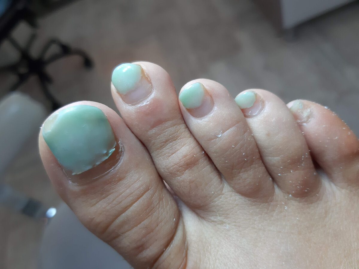 Если есть склонность к врастанию ногтей, это категорически делать нельзя, необходимо самостоятельно подпиливать ногти, не трогая при этом уголки. Зачастую помимо проблемы вросшего ногтя появляется еще одна – онихолизис.