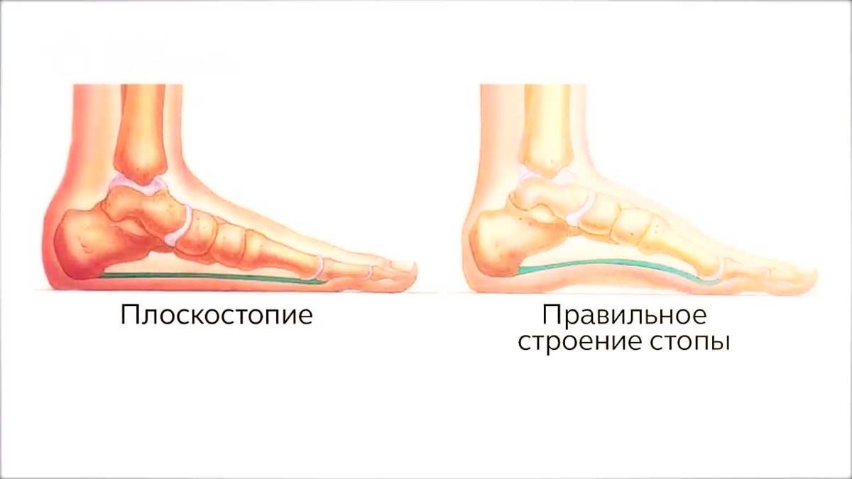 Плоскостопие - это не заболевание стоп | Сам Себе Ортопед. Спб. | Дзен