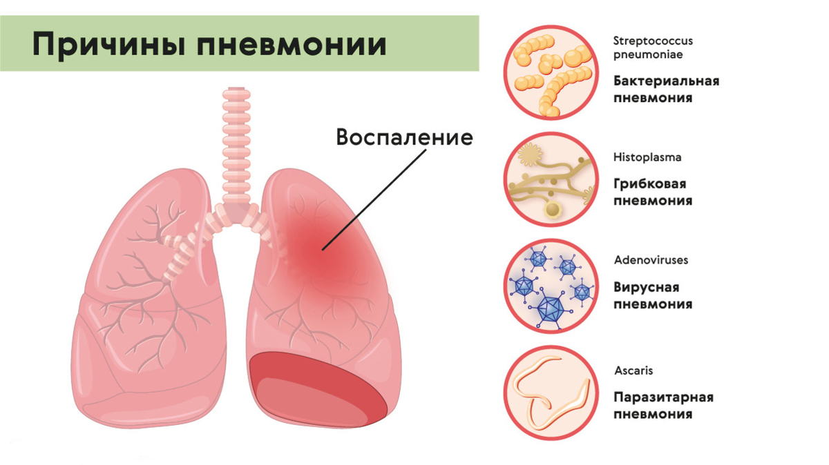 Сколько держится пневмония у детей