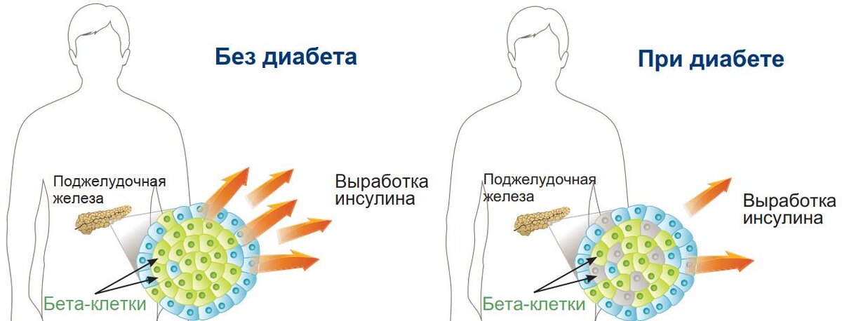 Проект сахарный диабет болезнь или образ жизни