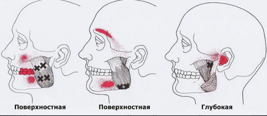 Карта точек боли в теле и точек напряжения мышц триггеры