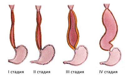 Пищевода 1 степени