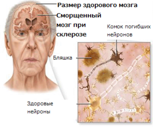 Старческий склероз: как выявить и что делать