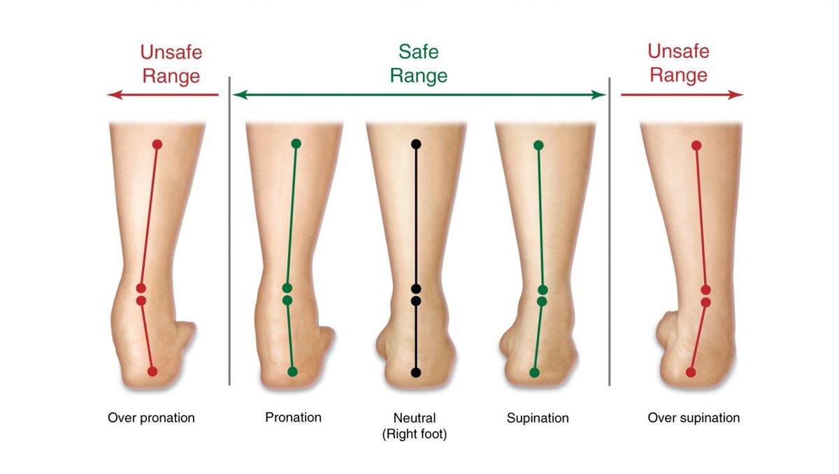 Гиперпронация и избыточная супинация (слева направо)