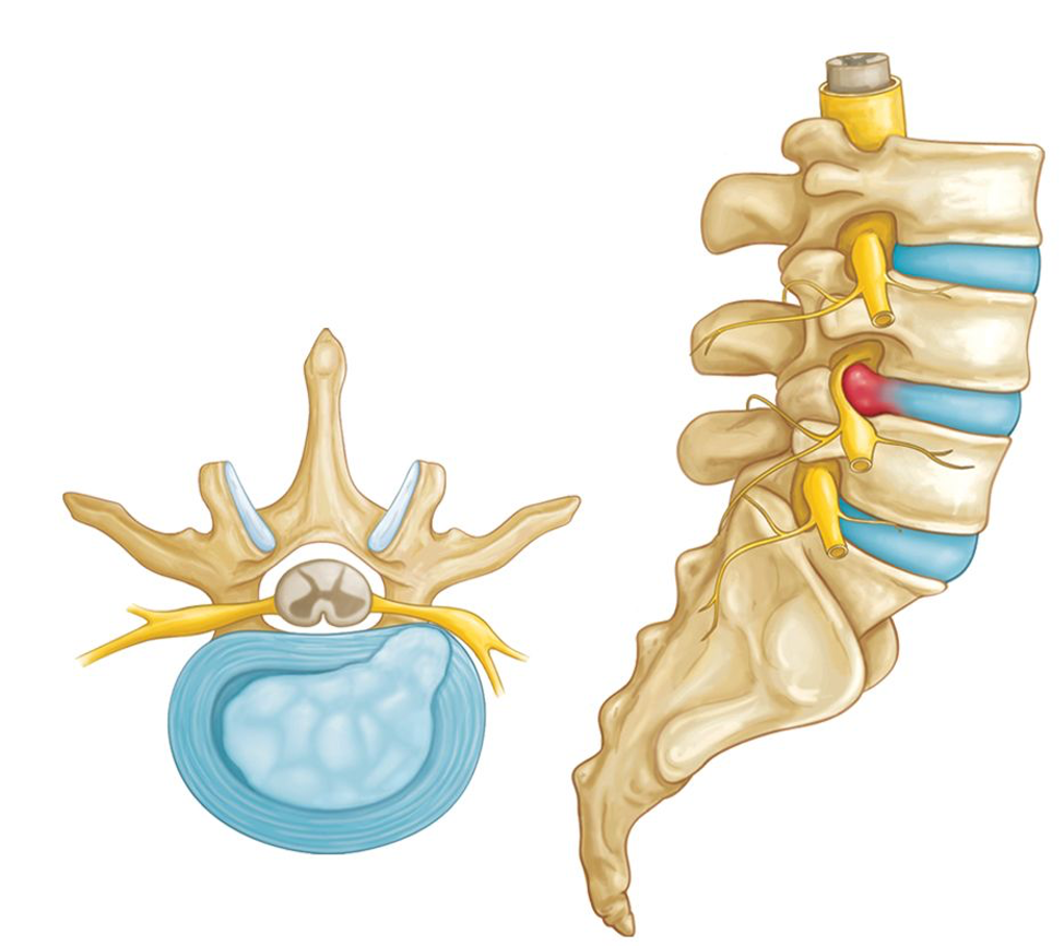 Протрузия диска на уровне l5 s1