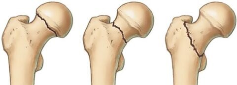  Различные осложнения, при переломе шейки бедренной кости, возникают довольно часто.