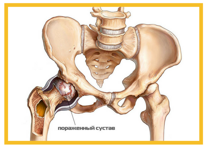 Коксартроз тазобедренного сустава.