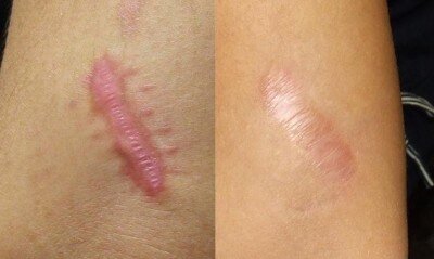 [caption id="attachment_1421" align="aligncenter" width="400"] Возникновение рубцов на поверхности кожного покрова может произойти в результате многочисленных причин[/caption]