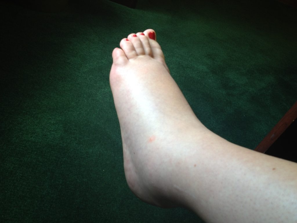 Отек при нефротическом синдроме