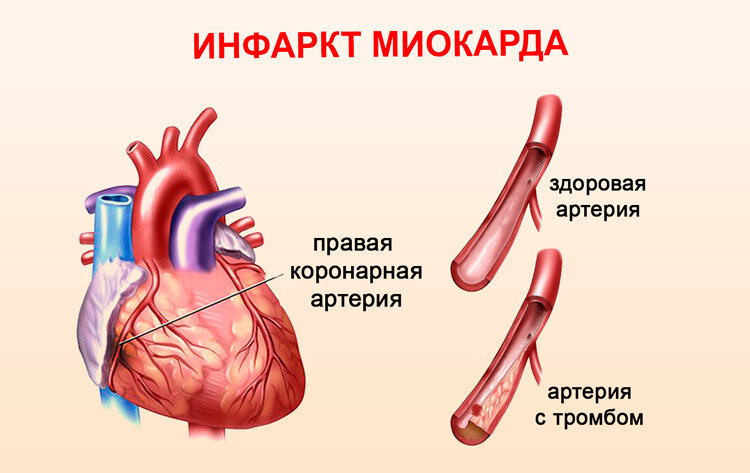 Специалисты опубликовали руководство, как заниматься сексом после инфаркта или с кардиостимулятором