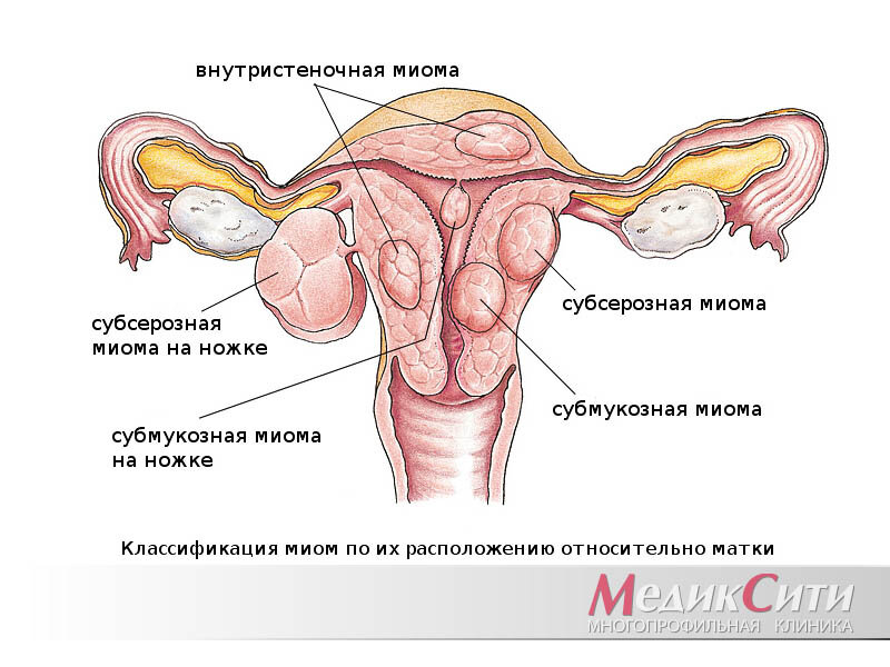 Миома матки