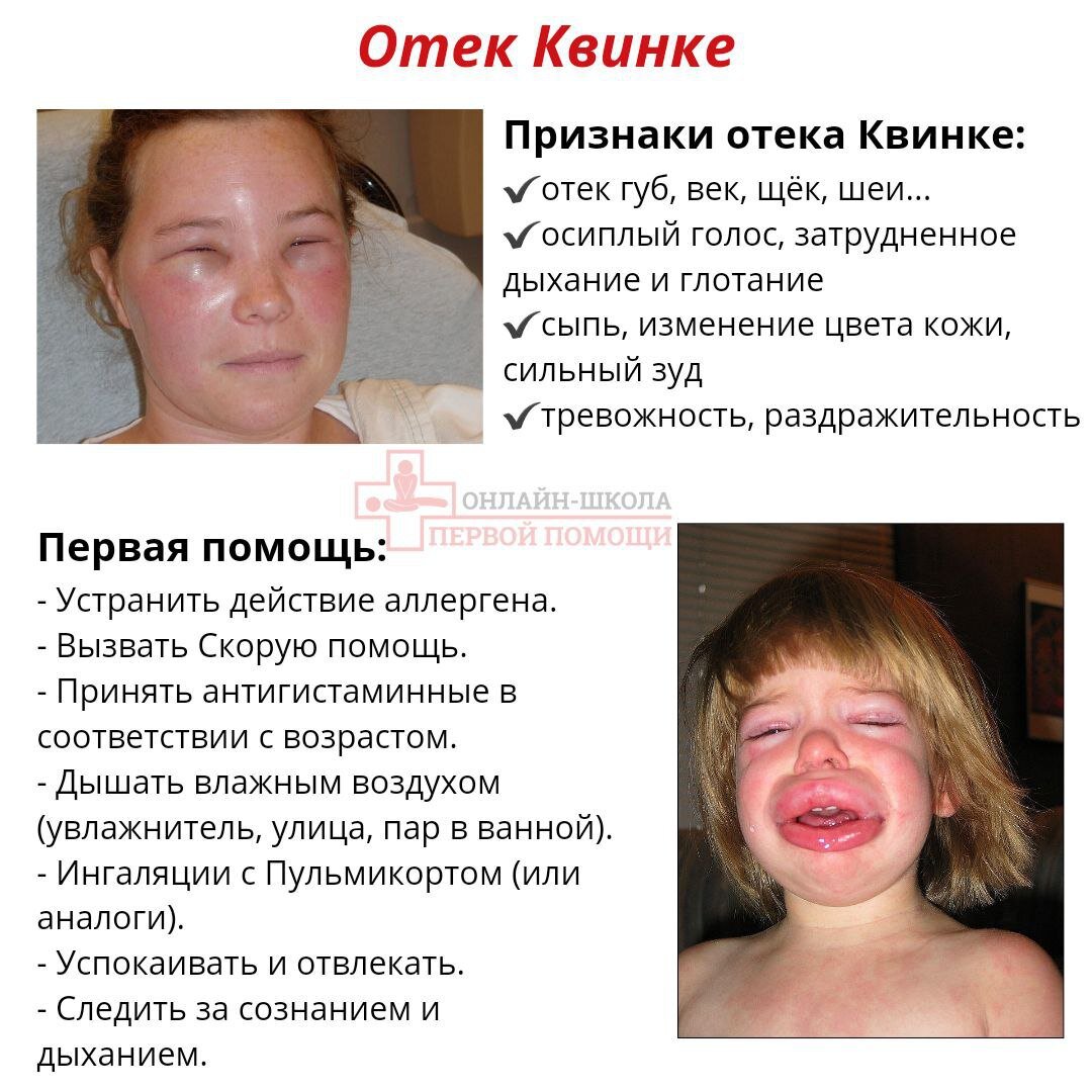 Признаки Отека Квинке и первая помощь