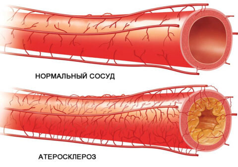 Пример здорового и загрязненного сосуда