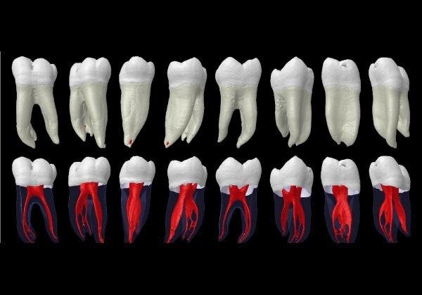 Как лечат корневые каналы зубов