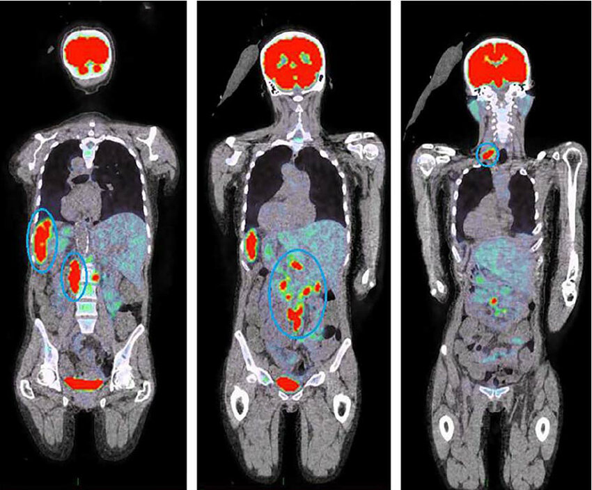 Пет тт. Позитрон-эмиссионная  томография: ПЭТ. Позитронно-эмиссионная трансаксиальная томография. ПЭТ кт с контрастированием. ПЭТ кт снимки метастазы.