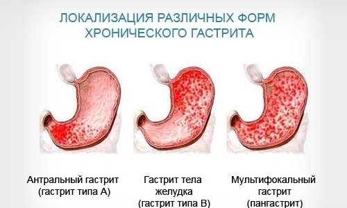 Антральный гастрит (тип в)