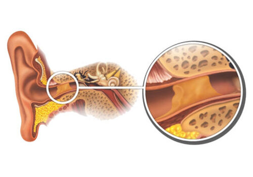 Шесть способов удаления серной пробки из уха