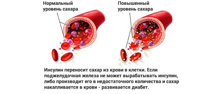 Как выглядит сахар в крови