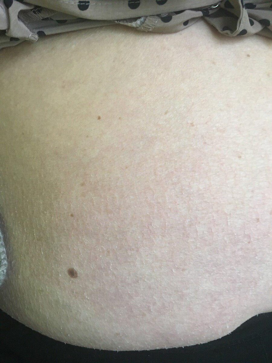 Это ремиссия. Во время обострения, всё тело покрывается чешуйками, как на руках.