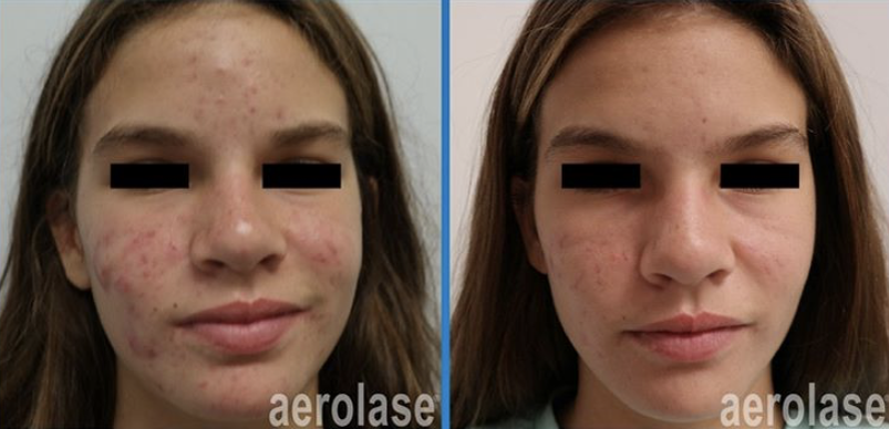 Результат лечения лазером aerolase