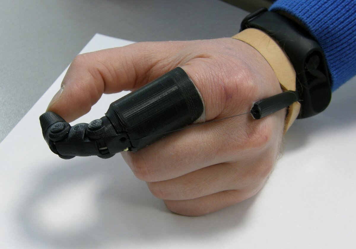 протез пальца Артёма Шмидта. фото с сайта http://gazeta-ps.ru