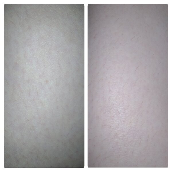 Фото ноги до и после процедуры