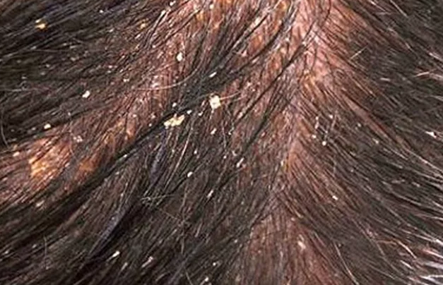 Жирная перхоть