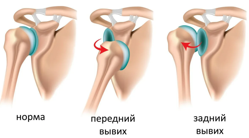 После вывиха может наблюдаться слабо выраженная атрофия мышц, а также снижение чувствительности в поврежденной области