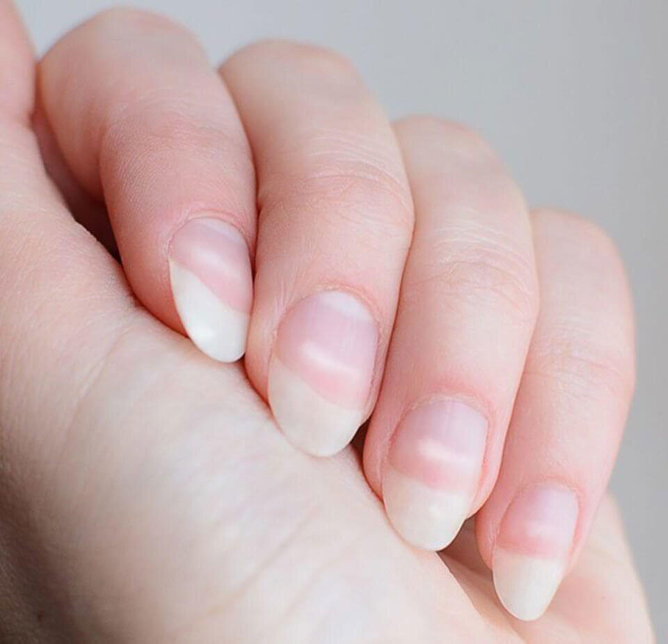 белые пятнышки на ногтях