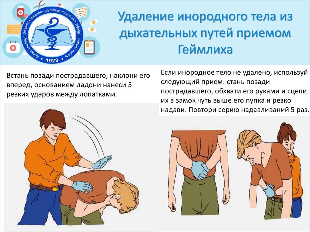 Подавился инородным телом. Если человек подавился прием Геймлиха. Приём Геймлиха при инородном теле. Прием при инородном теле дыхательных путей. Прием для удаления инородного тела из дыхательных путей.