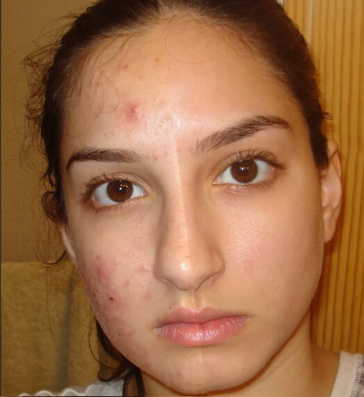 Мы объединили фото девушки до обработки акне и после, обратите внимание нет ни рубцов, ни пигментации