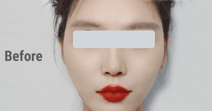 Популярная операция - "эльфийские ушки"