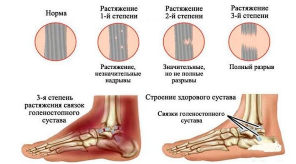 Потянула голеностоп. Неполный разрыв связок голеностопного сустава. Степени повреждения связок голеностопа. Надрыв связок голеностопного сустава гематома. Повреждение связок 2 голеностопа степени.