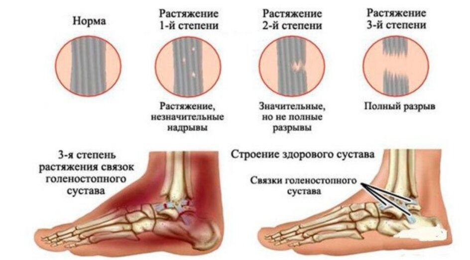 После растяжения связок. Неполный разрыв связок голеностопного сустава. Степени повреждения связок голеностопа. Надрыв связок голеностопного сустава гематома. Повреждение связок 2 голеностопа степени.