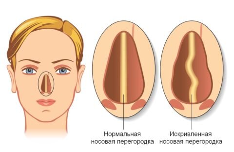  Искривление вертикальной пластинки