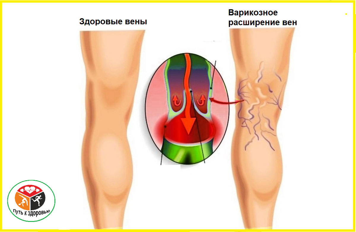Варикоз, Варикозное расширение вен